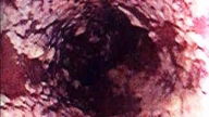 Candidiasis intestinal: síntomas y tratamiento