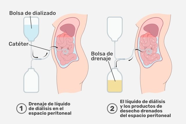Proceso de la diálisis peritoneal