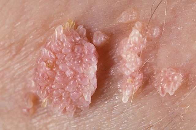 Papilloma és candida. A HPV fertőzöttség tünetei