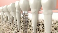Implantes dentales: qué son, beneficios y cómo se realiza 
