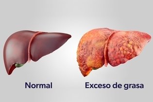 Imagen ilustrativa del artículo 8 principales síntomas de esteatosis hepática
