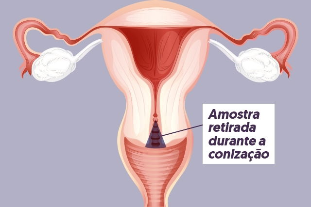 É normal sair um pedaço de carne na menstruação? 