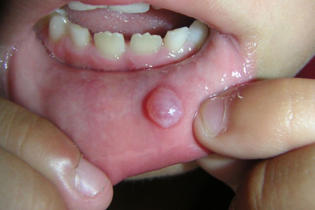 mucocele under tongue