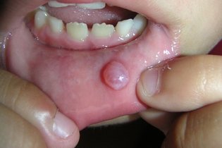 Illustrative image of the article Mucocele (Mucus Cyst): Symptoms, Causes & Treatment