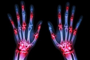 Imagen ilustrativa del artículo Artritis séptica: qué es, síntomas, diagnóstico y tratamiento