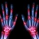 O que é artrite séptica, sintomas e como é o tratamento