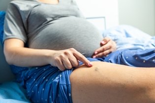 Imagem ilustrativa do artigo Varizes na gravidez: sintomas, causas, tratamento e como evitar