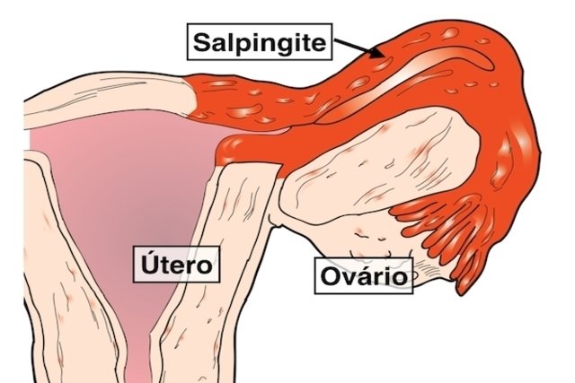 Ooforite ou ovarite? Entenda mais sobre essa inflamação!