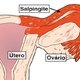 Saiba quais são os sintomas de inflamação nas trompas uterinas