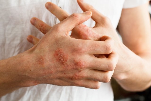 Imagem ilustrativa do artigo Eczema: o que é, sintomas, causas, tipos e tratamento