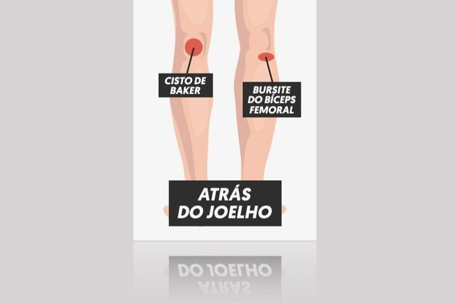 Dolor detrás de la rodilla: 10 causas y qué hacer - Tua Saúde