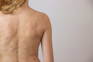 Imagem ilustrativa do artigo Carocinhos na pele: o que pode ser (e como tratar)