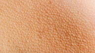 Keratosis Pilaris: Symptoms, Causes & Treatment Options