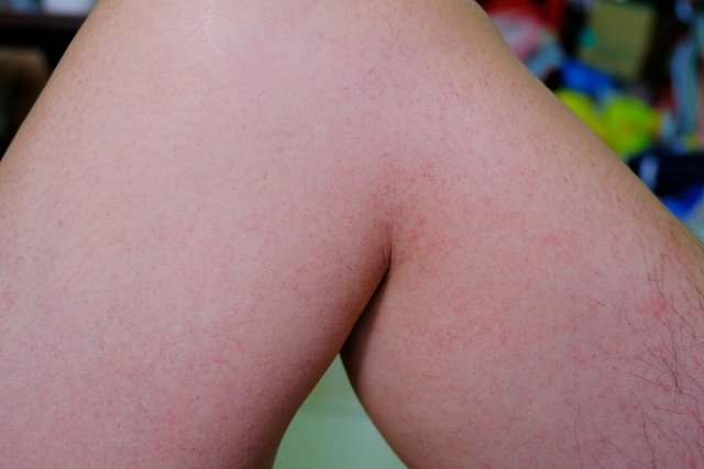 Imagen ilustrativa del artículo Manchas rojas en la piel: 19 causas y cómo quitarlas