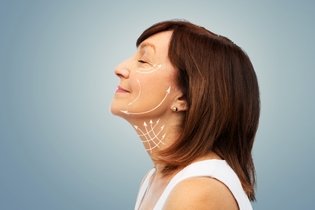 Imagem ilustrativa do artigo Lifting facial: o que é, quando é indicado e como é feito