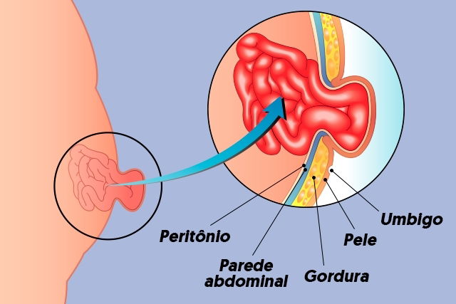 Sintomas de Hérnia Umbilical