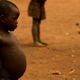 Kwashiorkor: o que é, sintomas, causas e tratamento