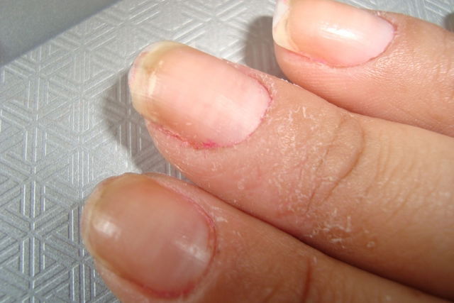 Toes Peeling in Strips: Is It Psoriasis Related? | MyPsoriasisTeam