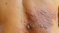 Dermatite herpetiforme: o que é, sintomas e tratamento