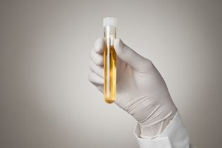 Gordura na urina: o que pode ser e o que fazer
