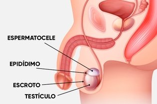 Imagem ilustrativa do artigo Espermatocele: o que é, sintomas, causas e tratamento
