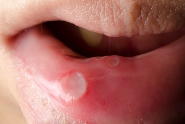 Sintomas do câncer de boca