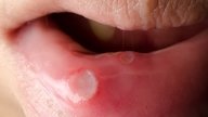 Câncer de boca: o que é, sintomas, causas e tratamento