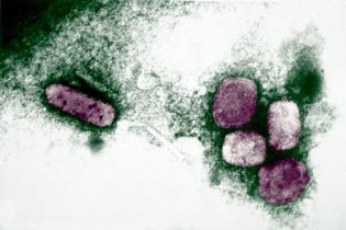 Imagem ilustrativa do artigo Varíola: o que é, sintomas, transmissão e tratamento