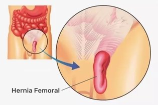 Hernia femoral: qué es, causas y tratamiento