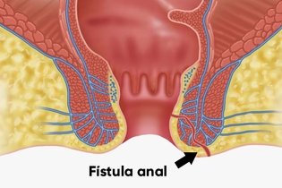 Imagen ilustrativa del artículo Fístula anal: qué es, síntomas y tratamiento  