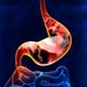 Hemorragia digestiva: qué es, principales causas y tratamiento