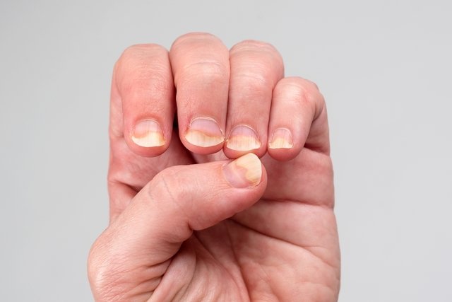 Nails: Infections, anemia, psoriasis: What nails can reveal about your  health - The Economic Times
