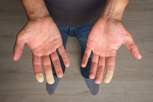 Illustrative image of the article Raynaud’s Syndrome: Symptoms, Causes & Treatment