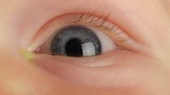 Remela no olho: 11 principais causas e o que fazer