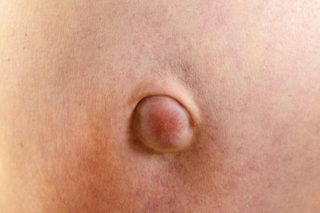 Hernia umbilical: causas, síntomas y tratamiento