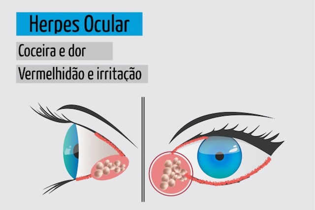 Conheca Os Sintomas Do Herpes Genital Labial E Ocular Tua Saude