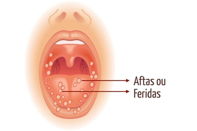 Como tratar aftas? - Hospital da Face