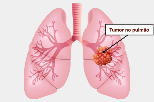 que es cancer de pulmon