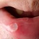 Cáncer bucal: síntomas, causas y prevención