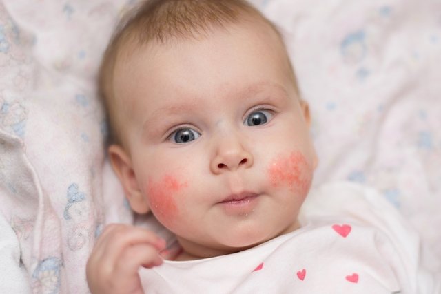 Foto de dermatite atópica no rosto do bebê