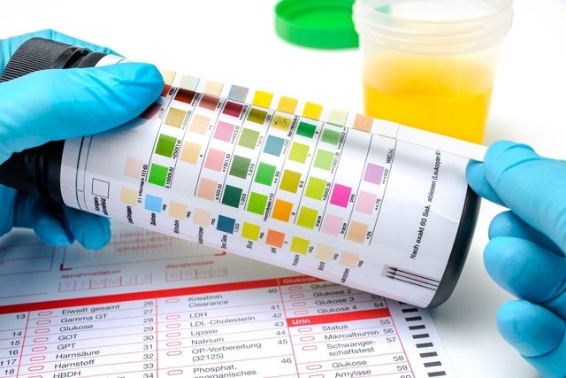 Leukocytes In Urine Top 6 Causes Tests And Normal Levels Tua Saúde 5602