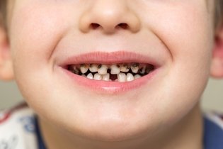 Imagem ilustrativa do artigo Dente podre: 4 principais causas (e como tratar)