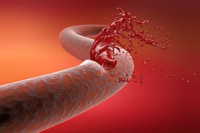 O que é uma hemorragia interna e quais os sinais e sintomas