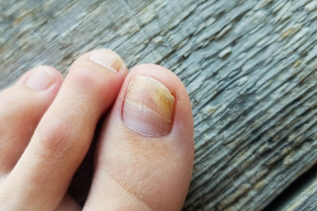 Why are my nails yellow at the tips? - Quora