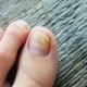 Yellow Nails: 6 Common Causes & What to Do