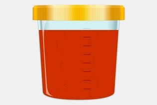 Illustrative image of the article Red Urine: 11 Common Causes & What to Do