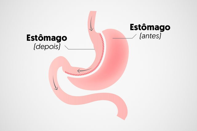 Cirurgia bariátrica: tipos, quando fazer, vantagens e riscos - Tua