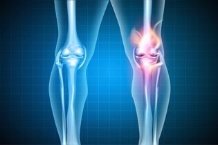 Imagen ilustrativa del artículo Tratamiento de lesión en los ligamentos de la rodilla