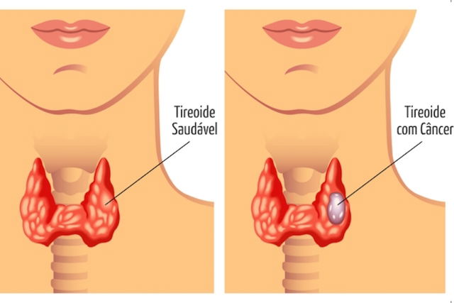 Tratamento do Hipertireoidismo Remédios e Cirurgia Tua Saúde