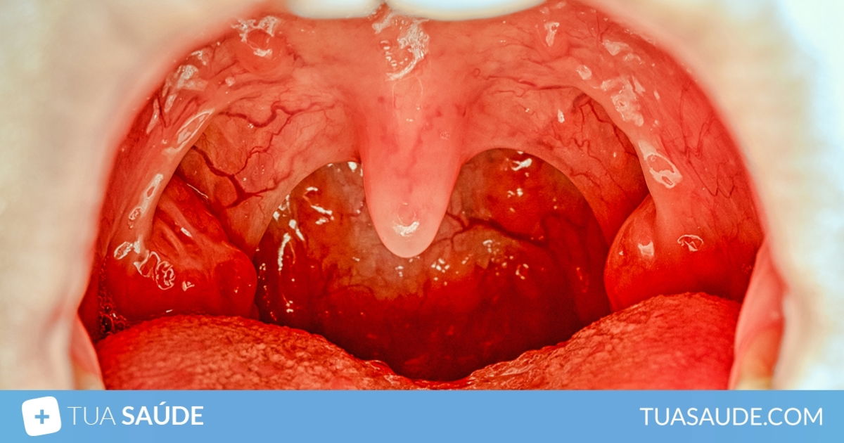 Amigdalite: como saber se ? viral ou bacteriana (e tratamento) - Tua Sa?de